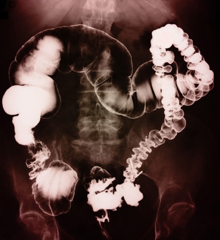 Colonoscopy Torrance CA | Long Beach CA